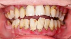 Membersihkan Karang Gigi dengan Bahan Alami: Efektif atau Hanya Mitos?