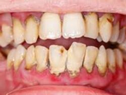 Membersihkan Karang Gigi dengan Bahan Alami: Efektif atau Hanya Mitos?