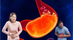 Mencegah dan Mengobati Asam Lambung: Panduan Lengkap untuk Kesehatan Pencernaan