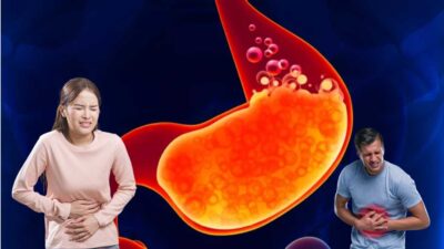 Mencegah dan Mengobati Asam Lambung: Panduan Lengkap untuk Kesehatan Pencernaan