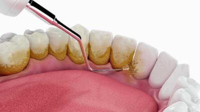 Bukan Sekadar Sikat Gigi: Ini Cara Tepat Membersihkan Karang Gigi